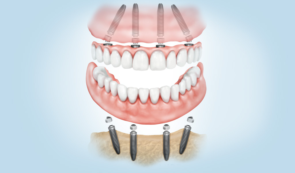 implantes dentales en Indautxu - Bilbao