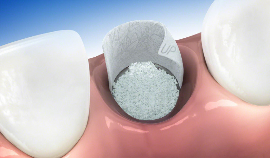 implantes dentales en Indautxu - Bilbao