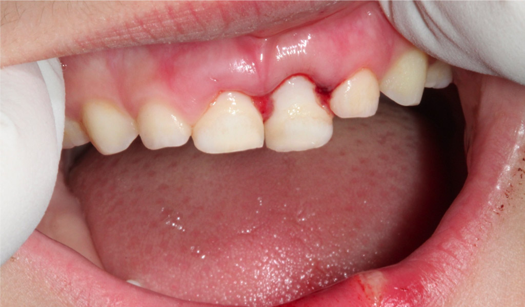 urgencias dentales en Indautxu - Bilbao 